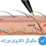 چگونگی الکترولیز موهای زائد