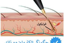 چگونگی الکترولیز موهای زائد