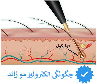 چگونگی الکترولیز موهای زائد