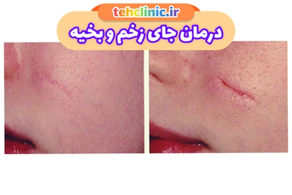 لیزر جای زخم و بخیه در تهران