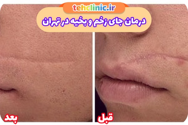 لیزر جای زخم و بخیه در تهران