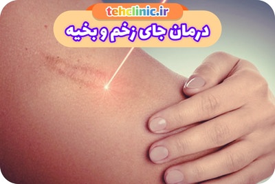 لیزر جای زخم و بخیه در تهران