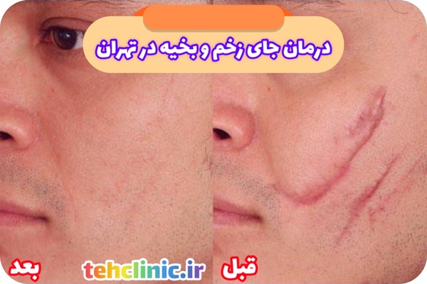 لیزر جای زخم و بخیه در تهران