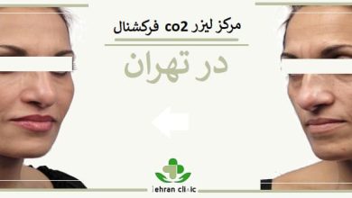 مرکز لیزر co2 فرکشنال در تهران