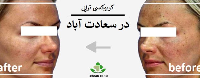 کربوکسی تراپی در سعادت آباد