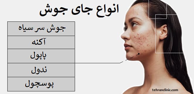 انواع جای جوش