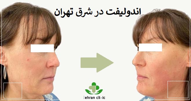 اندولیفت در شرق تهران