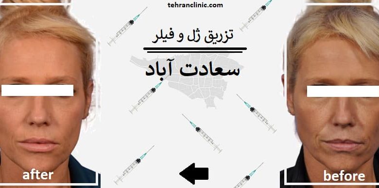 تزریق ژل و فیلر سعادت آباد