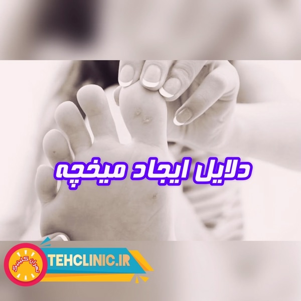 دلایل ایجاد میخچه