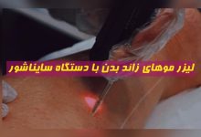 لیزر موهای زائد بدن با دستگاه سایناشور معرفی مراکز در سایت تهران کلینیک