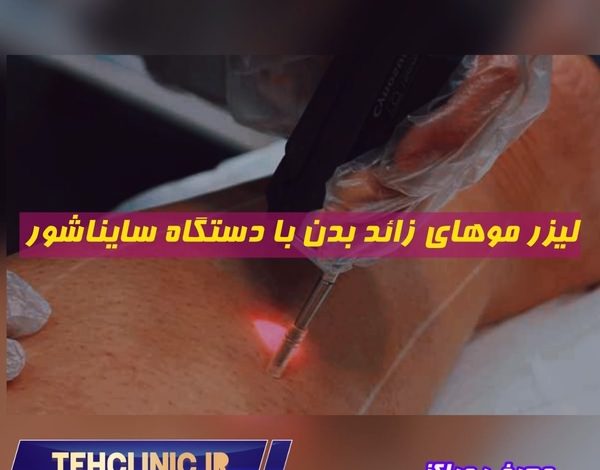 لیزر موهای زائد بدن با دستگاه سایناشور معرفی مراکز در سایت تهران کلینیک