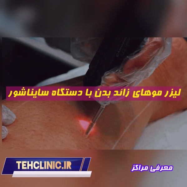 لیزر موهای زائد بدن با دستگاه سایناشور معرفی مراکز در سایت تهران کلینیک