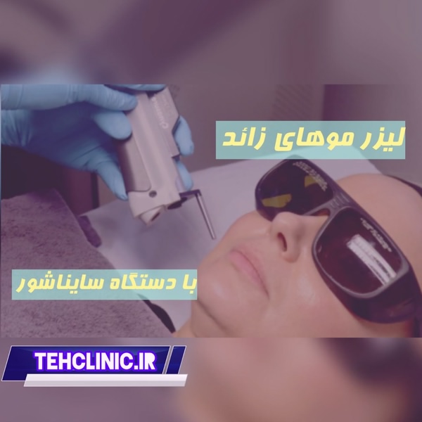 لیزر موهای زائد با دستگاه سایناشور