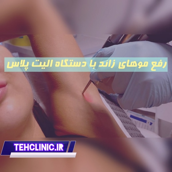 رفع موهای زائد با دستگاه سایناشور