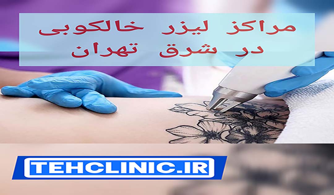 مراکز لیزر خالکوبی در شرق تهران - tehclinic.ir