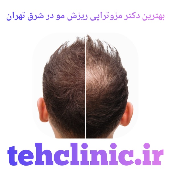 بهترین دکتر مزوتراپی ریزش مو در شرق تهران