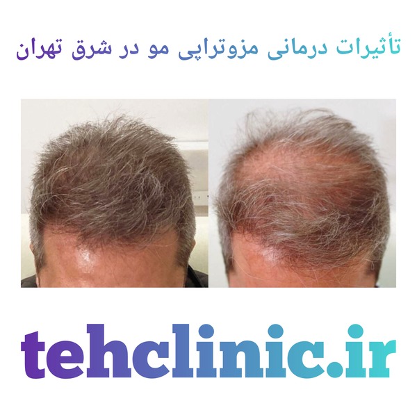 تأثیرات درمانی مزوتراپی مو در شرق تهران