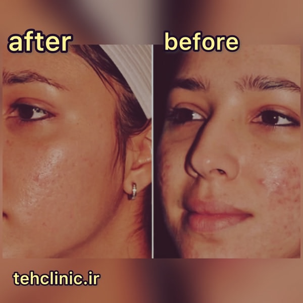 میکرونیدلینگ قبل و بعد