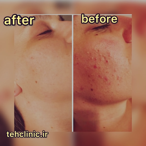 میکرونیدلینگ قبل و بعد