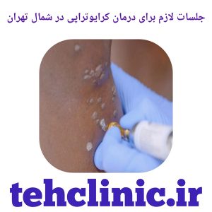 جلسات لازم برای درمان کرایوتراپی در شمال تهران