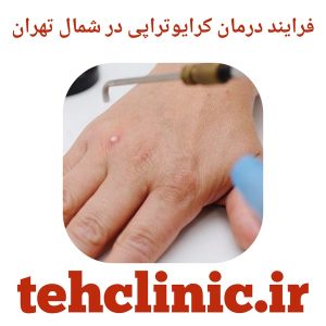 فرایند درمان کرایوتراپی در شمال تهران