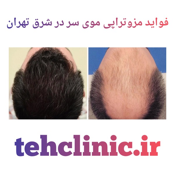 فواید مزوتراپی موی سر در شرق تهران