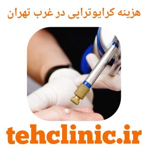 هزینه کرایوتراپی در غرب تهران