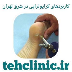 کاربردهای کرایوتراپی در شرق تهران