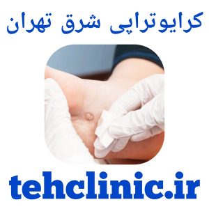 کرایوتراپی شرق تهران