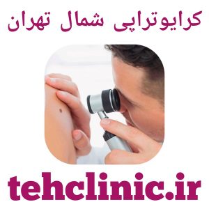 کرایوتراپی شمال تهران