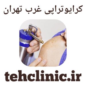 کرایوتراپی غرب تهران