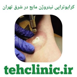 کرایوتراپی نیتروژن مایع در شرق تهران