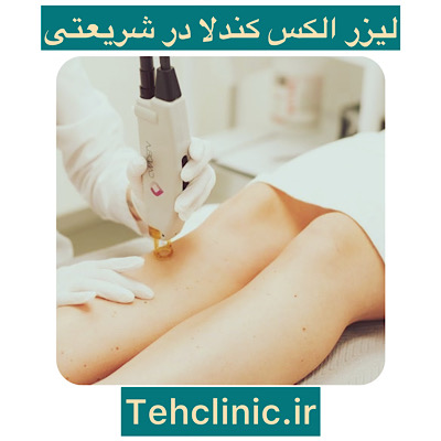 لیزر الکس کندلا در شریعتی