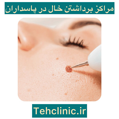 بهترین مراکز برداشتن خال در پاسداران تهران