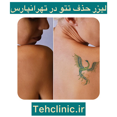 پاک کردن تاتو در تهرانپارس