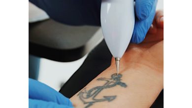 پاک کردن تاتو در تهرانپارس
