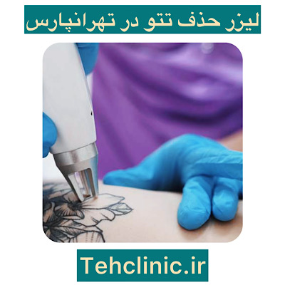 پاک کردن تاتو در تهرانپارس