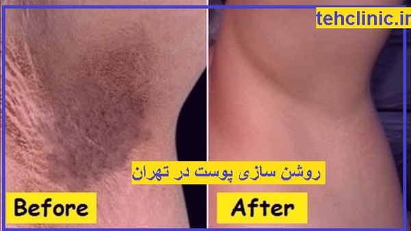 روشن سازی پوست در تهران