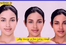 روشن سازی پوست در تهران
