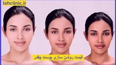 روشن سازی پوست در تهران