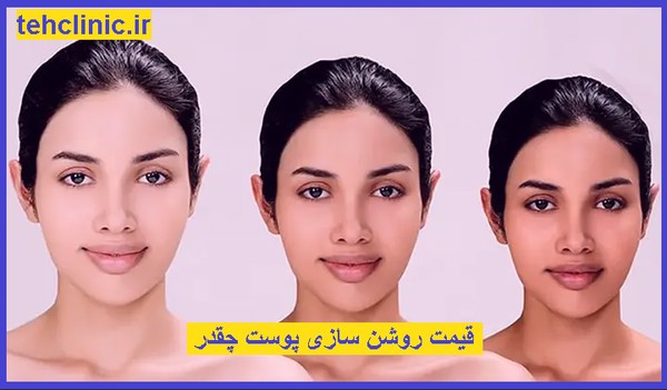 روشن سازی پوست در تهران