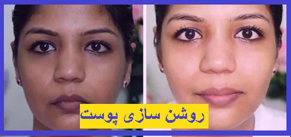 روشن سازی پوست در تهران