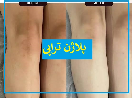 پلاژن تراپی