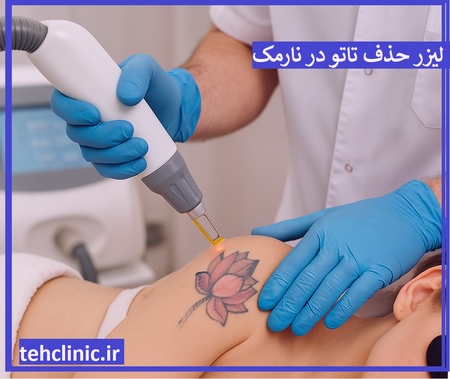 لیزر پاک کردن تاتو در نارمک