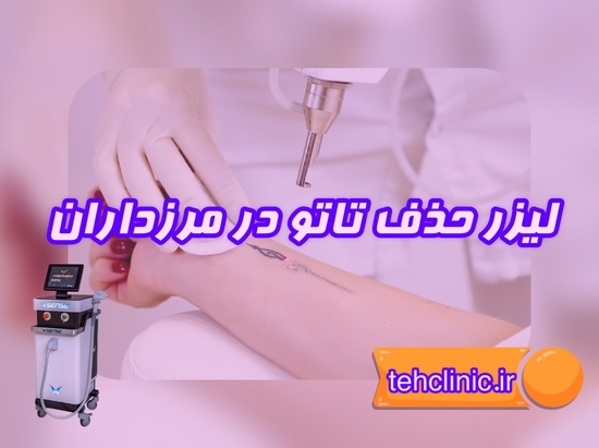 مرکز لیزر پاک کردن تاتو در مرزداران