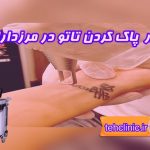 مرکز لیزر پاک کردن تاتو در مرزداران
