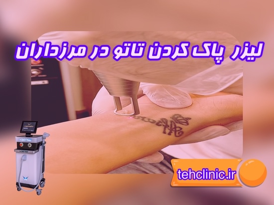 مرکز لیزر پاک کردن تاتو در مرزداران