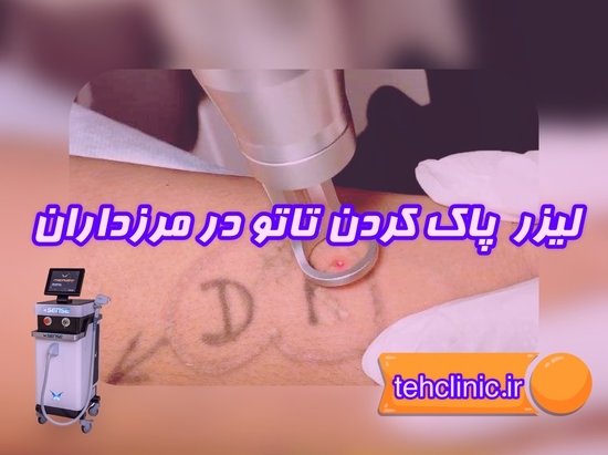 مرکز لیزر پاک کردن تاتو در مرزداران