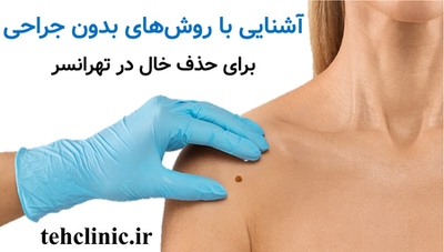 آشنایی با روش‌های بدون جراحی برای حذف خال در تهرانسر