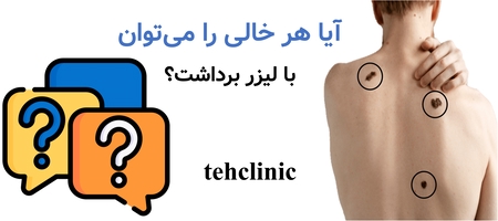 آیا هر خالی را می‌توان با لیزر برداشت؟